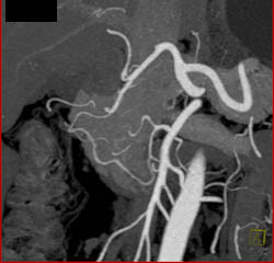 Median Arcuate Ligament Syndrome - CTisus CT Scan