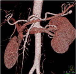 Fibromuscular Dysplasia (FMD) - CTisus CT Scan