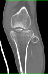 Spasm Popliteal Artery S/P Trauma With Tibial Plateau Fracture - CTisus CT Scan