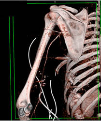 GSW Shoulder With Injury Distal Artery - CTisus CT Scan