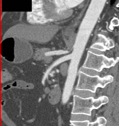 Median Arcuate Ligament Syndrome - MALS - CTisus CT Scan