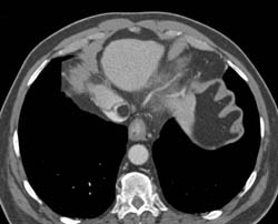 Pseudo-clot Inferior Vena Cava (IVC) - CTisus CT Scan