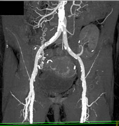 SFA With Vessel Tracking - CTisus CT Scan