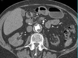 Plaque and Ulcers in Abdominal Aorta - CTisus CT Scan