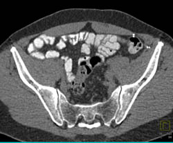 Patent SFA and External Iliac Artery - CTisus CT Scan