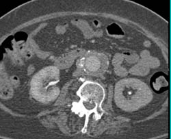 Aorto-enteric Fistulae - CTisus CT Scan