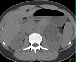 Ureteropelvic Junction (UPJ) on Left Due to Crossing Renal Artery - CTisus CT Scan