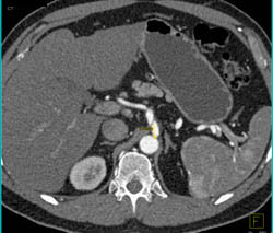 Vasculitis With SMA/celiac Dissections and Vasculitis - CTisus CT Scan