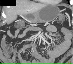 Normal Vasa Recta to Small Bowel - CTisus CT Scan