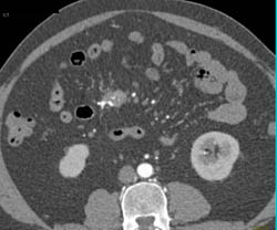 Carcinoid Encases Branches of Superior Mesenteric Artery (SMA) and Superior Mesenteric Vein (SMV) - CTisus CT Scan