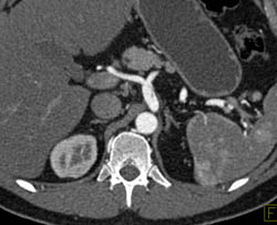 Vasculitis With Multiple Dissections in Celiac and SMA - CTisus CT Scan