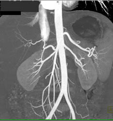 Replaced Right Hepatic Off SMA - CTisus CT Scan