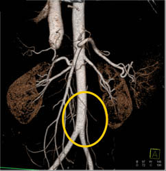 IMA Seen Best on VRT - CTisus CT Scan