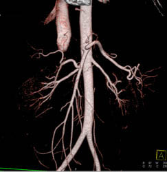 Normal Aorta Branching on Flash Mode - CTisus CT Scan