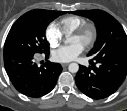 Nodes in Hilum Without Pulmonary Arteriovenous Malformation (PAVM) - CTisus CT Scan