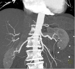 Fibromuscular Dysplasia (FMD) of Both Renal Arteries in VRT and MIP - CTisus CT Scan