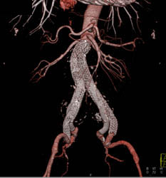 Endovascular Repair of Abdominal Aortic Aneurysm (AAA) - CTisus CT Scan