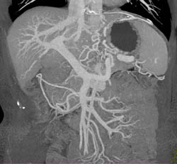 Cirrhosis With Portal Hypertension - CTisus CT Scan