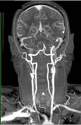 Dual Energy With Bone Subtraction - CTisus CT Scan