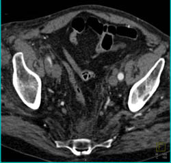 Dissection Right External Iliac Artery - CTisus CT Scan