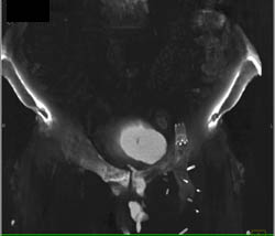 Stent in Iliac Artery - CTisus CT Scan