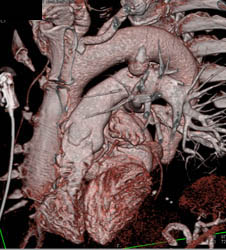 Ductus Aneurysm - CTisus CT Scan