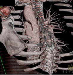 Type B Dissection With Endovascular Stent Without Leak - CTisus CT Scan