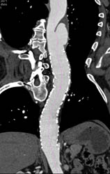 Ductus Aneurysm - CTisus CT Scan