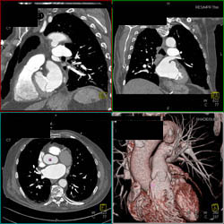 Iliac Disease - CTisus CT Scan