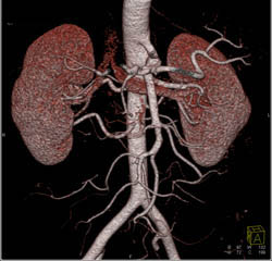 Celiac Aneurysm - CTisus CT Scan