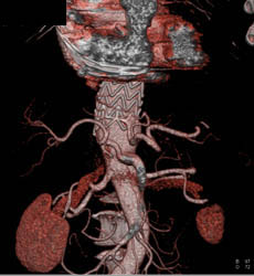 Endovascular Stent Extends to Level of Celiac Artery - CTisus CT Scan