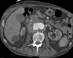 Ulceration of Aorta With Peri-aortic Blood - CTisus CT Scan