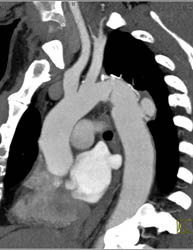 Ulceration of Aortic Arch - CTisus CT Scan