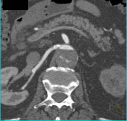 False Lumen Compresses the True Lumen - CTisus CT Scan