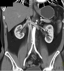 IVC Stent Following Repair - CTisus CT Scan