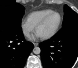 Clot in Aorta and Focal Dissection SMA - CTisus CT Scan