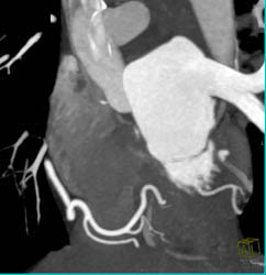 Normal Right Dominant Circulation - CTisus CT Scan