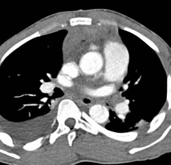 Type A Dissection With Bleed - CTisus CT Scan