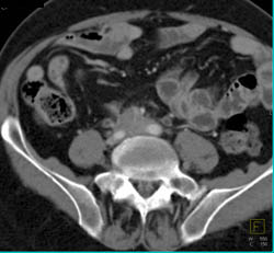 Fibrosis Around Iliac Artery - CTisus CT Scan