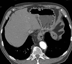 Vasculitis With Focal Dissections Off SMA - CTisus CT Scan