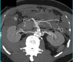 Repair of Abdominal Aortic Aneurysm (AAA) With Graft in 3D Using VRT and MIP - CTisus CT Scan