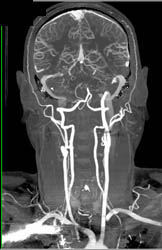 CTA of Cranial Circulation With Bone Removal on Dual Energy - CTisus CT Scan