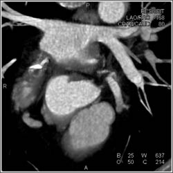 Pseudoaneurysm Aortic Root - CTisus CT Scan