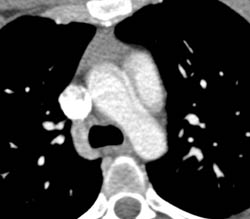 Artifact Simulates An Aortic Dissection - CTisus CT Scan