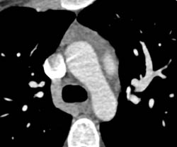 Gated Acquisition Defines No Evidence of Dissections - CTisus CT Scan