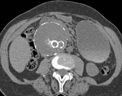 Endovascular Stent Without Leak and This Case Shows the Importance of A Non-contrast Scan - CTisus CT Scan