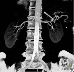 Prehilar Branching of the Left Renal Artery - CTisus CT Scan