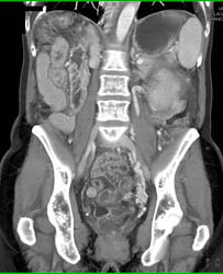 Prominent Pelvic Collaterals - CTisus CT Scan