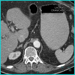 SMA Occlusion Easiest to See on the Sagittal View - CTisus CT Scan