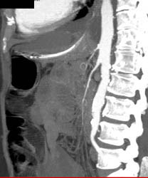 Low Flow State With Small Caliber SMA and Celiac Artery - CTisus CT Scan